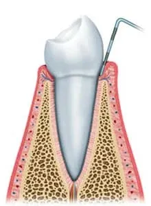 牙周诊疗详细介绍 11