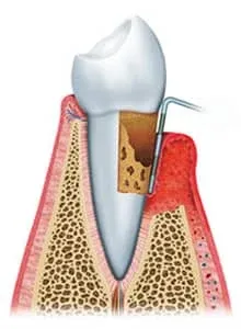 牙周诊疗详细介绍 17