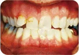 牙周诊疗详细介绍 27