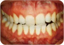 牙周诊疗详细介绍 23