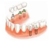 1655444146-牙齿缺失的修复方式-种植牙