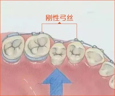 牙齿矫正详细介绍 53