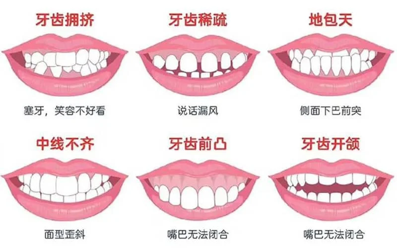 曲靖牙齿矫正咨询解答-哪些牙齿需要矫正？ 3