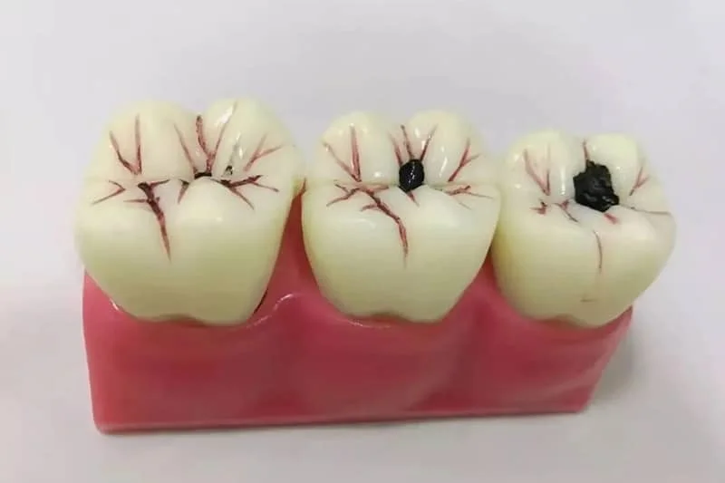 补牙后注意事项 1