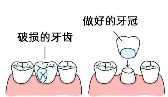 3d烤瓷牙多少钱一颗？附安装烤瓷牙后注意事项 25