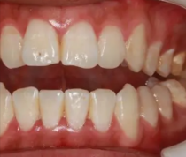 牙齿开颌牙不矫正会有什么后果？注意导致产生颌骨畸形 3