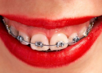 牙齿开颌牙不矫正会有什么后果？注意导致产生颌骨畸形 1