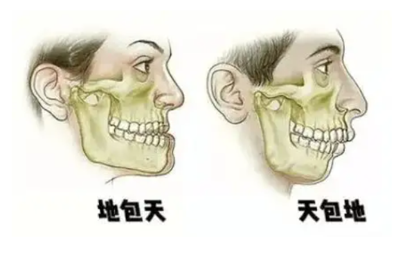 地包天有必要矫正吗？附牙齿矫正项目收费价格 5