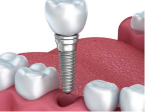 大连齿医生口腔门诊种植牙怎么样？一家大型牙科品质值得信赖