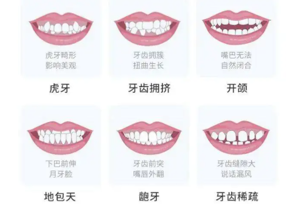 牙齿矫正有年龄限制吗？附牙齿矫正收费价格 1