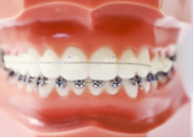 牙齿开颌牙不矫正会有什么后果？注意导致产生颌骨畸形 5