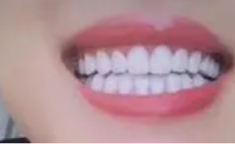 镶牙价格一般多少钱一颗？镶完牙注意事项 3